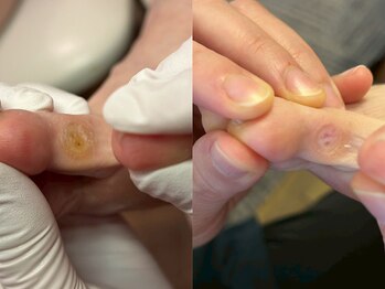 ルーム ノヘア(Room nohea)/【フットケア】指間の魚の目