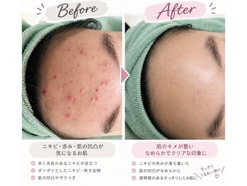 サロン デ モンターニユ(SALON DES montagnes)の写真/【繰り返すニキビ】もう悩まない！トラブルから卒業を目指す特別なサロンケア☆