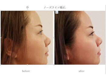 プラナ(PRANA)/ノーズライン矯正　before/after