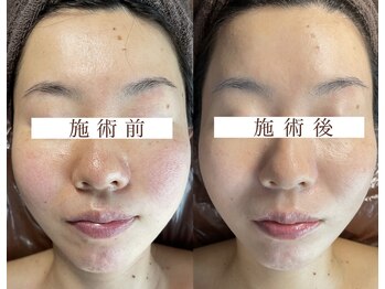 エスデザイン(es design)/くすみ改善/赤み肌/谷山エステ