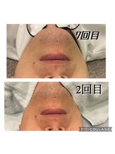 レイモード(Ray mode)/ヒゲ脱毛爆抜け7回目