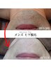 メンズ 本格★ヒゲ脱毛（顔全体）体験 4950円 【高保湿パック付】