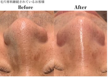 フレイヤ(FREYA)/毛穴専科Before→After