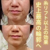 目元 口元のたるみ 眉間シワ改善専門サロン