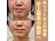 目元 口元のたるみ 眉間シワ改善専門サロンの写真