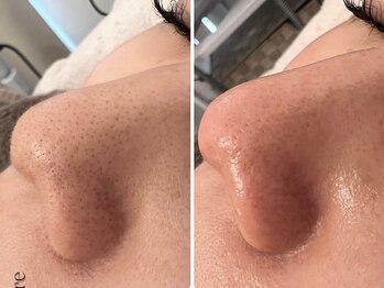 5つ星/◆ハイドロ毛穴洗浄