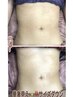 ★ER200温まり倍速インディバボディ60分♪浮き輪肉を撃退★肩凝り美容術後