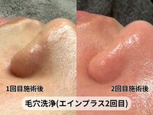 アルピナ(ALPINA)/毛穴洗浄で黒ずみおさらば！