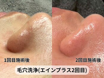 アルピナ(ALPINA)/毛穴洗浄で黒ずみおさらば！