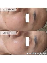 ネイルズビー 別邸(Nail's be)/法令線にもハーブピーリング