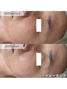 ネイルズビー 別邸(Nail's be)/法令線にもハーブピーリング