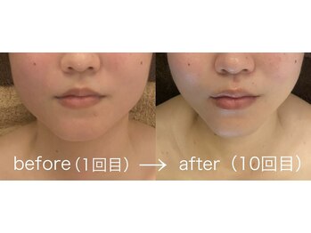 プール エドボリ(POOL EDOBORI)/小顔コルギ効果