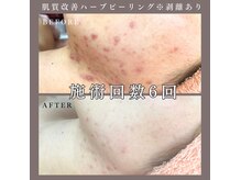 ベルミー(Bellmi)の雰囲気（当店人気No1!剥離ありハーブピーリングで根本ケア【ニキビケア】）