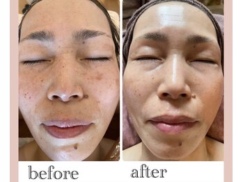 シンデレラ しみケア(Cinderella)/シミケアプログラム