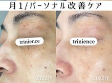 トリニエンス 新宿店(TRINIENCE)/40代/シミケア/パーソナルケア