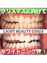 ライトビューティー 銀座店(LightBeauty)/東銀座 ホワイトニング症例写真