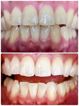 コントレール 歯ぁと(CONTRAIL)/ビフォーアフター