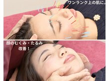 あおき鍼灸整骨院の雰囲気（美容鍼×手技）