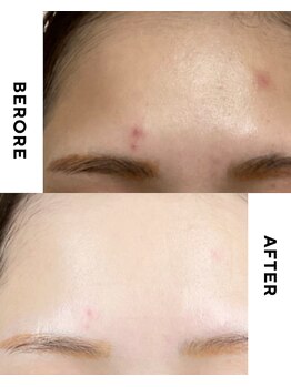 ターミナルジム アンド ビューティーサロン(TERMINAL GYM&BEAUTY SALON)/ニキビケア