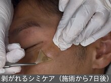 オアシスラグーン(OASIS LAGOON)/剥がれる!!シミのポイントケア