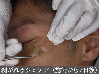 オアシスラグーン(OASIS LAGOON)/剥がれる!!シミのポイントケア