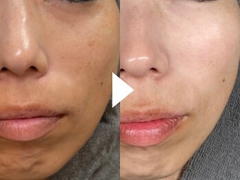 アンドアンド(&and)の写真/《ツヤ溢れる水光白玉肌に♪》『トラネキサム酸』と『グルタチオン』でくすみ・色むらのない明るい肌へ◎
