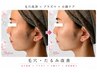 【毛穴・たるみ改善】毛穴洗浄×プラズマ×小顔ケア ¥40,700→¥18,700