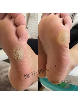 サロン マリス(salon Mariss)/角質除去、タコのケア!