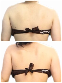 リリィブラン(Lily branc)/ブライダル痩身