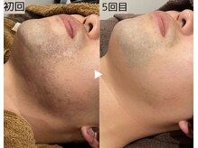 ロワ(Roi)/【肌荒れ改善×顔脱毛】5回施術