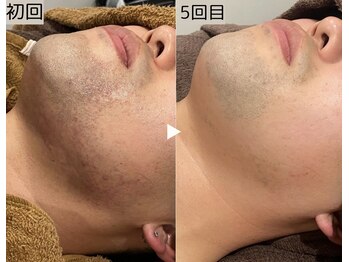 ロワ(Roi)/【肌荒れ改善×顔脱毛】5回施術