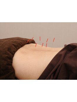 鍼灸施術を受けたい