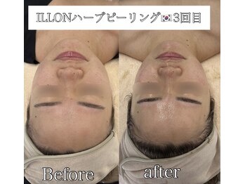 ラ ミュエル(La miel)/結果重視！韓国ILLONハーブ