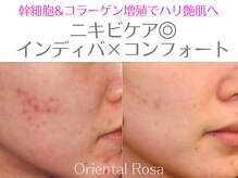 オリエンタルローザ 表参道(Oriental Rosa)/ニキビケア特化フェイシャル♪