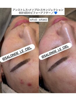 サロンドゥルシェル(salonde_le ciel)/アンストレス×ILLON