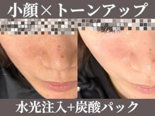 マヴィ 藤井寺店(MavY.)/水光注入+炭酸パック