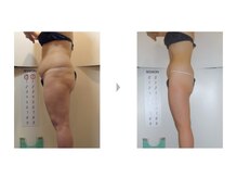 Nビューティー/最新エンダモロジーBODY