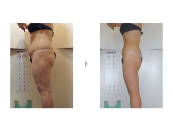 Nビューティー/最新エンダモロジーBODY