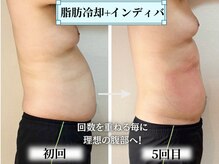 ブルー(Blue)の雰囲気（脂肪冷却★最先端3D冷却マシーンで結果出し！月1回30分の施術！）