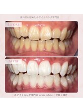 エクシアホワイトニング 札幌中島公園店/Before After［ホワイトニング］