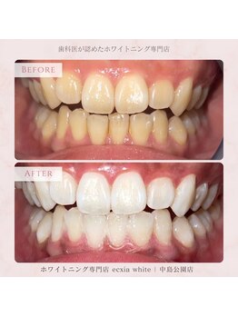 エクシアホワイトニング 札幌中島公園店/Before After［ホワイトニング］