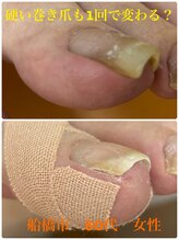 巻き爪じゅん 船橋店/硬い巻き爪も1回で変わる？