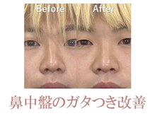 ラプリボーテ(Raplit BEAUTE)/隆鼻＋輪郭矯正40分10回