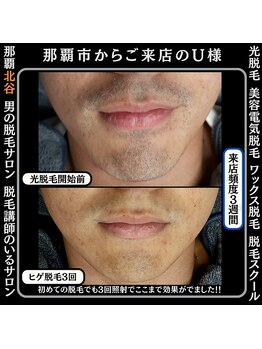 ディースタイル 北谷店(Dstyle)/北谷メンズ脱毛ヒゲBefore after