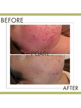 ポアレ(POARE)/赤みが消えなくて悩んでた