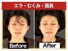 エレヴィザ トウキョウ 恵比寿院(ELVISA TOKYO)/エラ・むくみ・面長が気になる