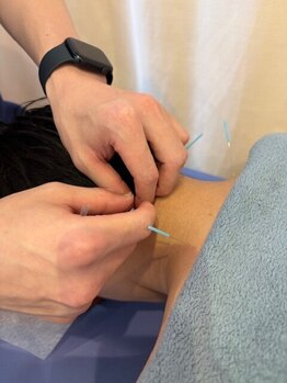 鍼灸施術を受けたい