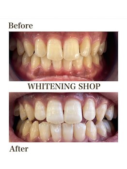 ホワイトニングショップ 津店/Before After/1回(初回体験)