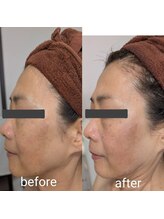 リルーチェ 倉敷(Riluce)/ヒト幹細胞導入1回の施術