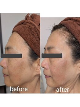 リルーチェ 倉敷(Riluce)/ヒト幹細胞導入1回の施術